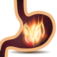 IC and Prelief:  8 Ways to Manage an Acid Stomach